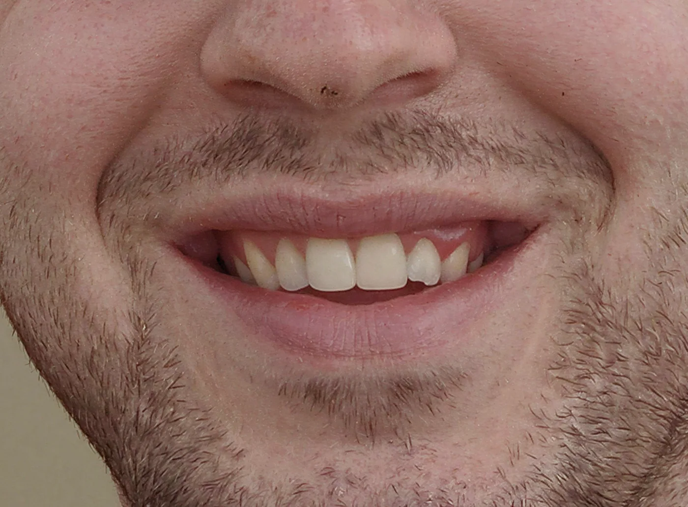 Sonrisa gingival - antes