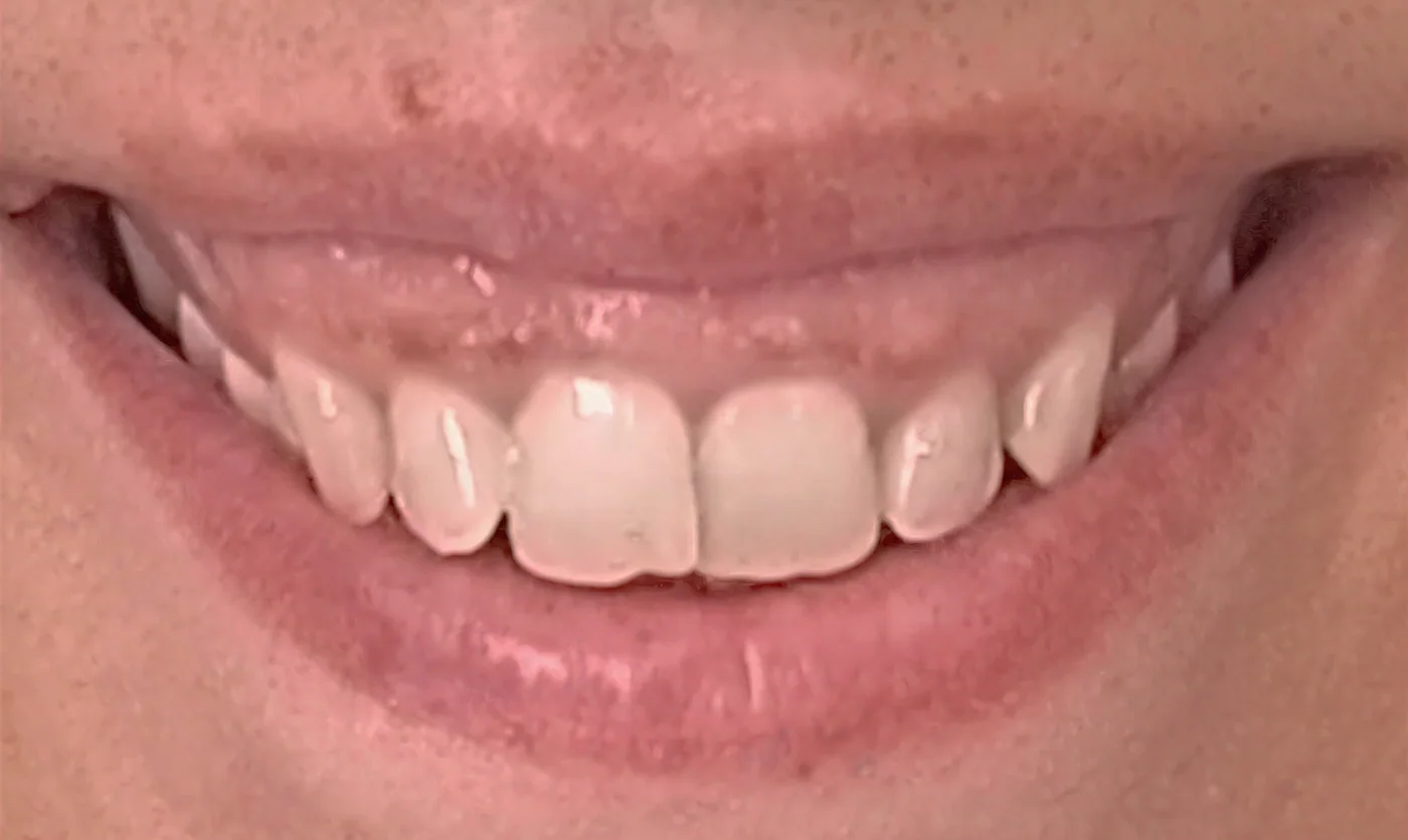 Sonrisa gingival - antes