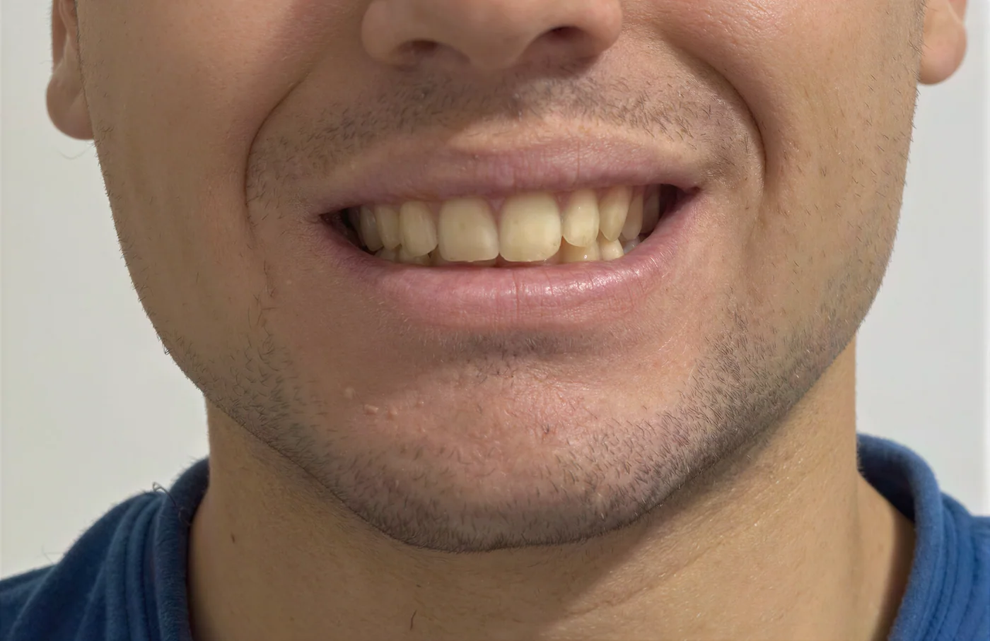 Sonrisa - antes
