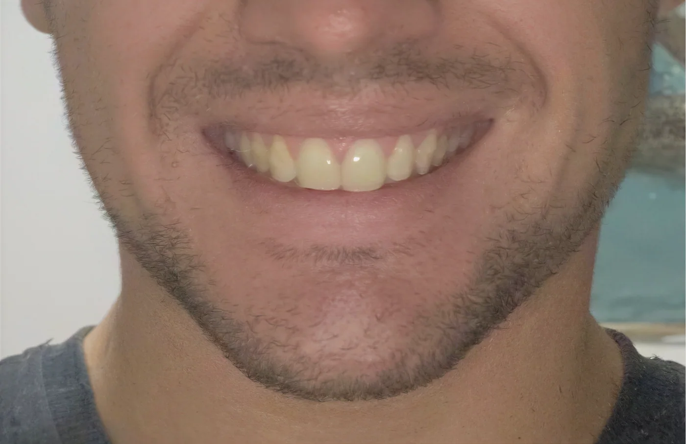 Sonrisa - después (paladar expandido)